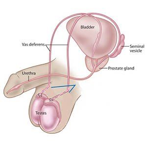 best of Blockage deferens sperm