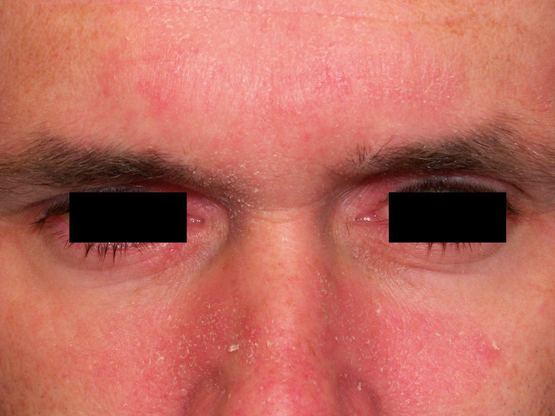 Facial rash hypothyroidism