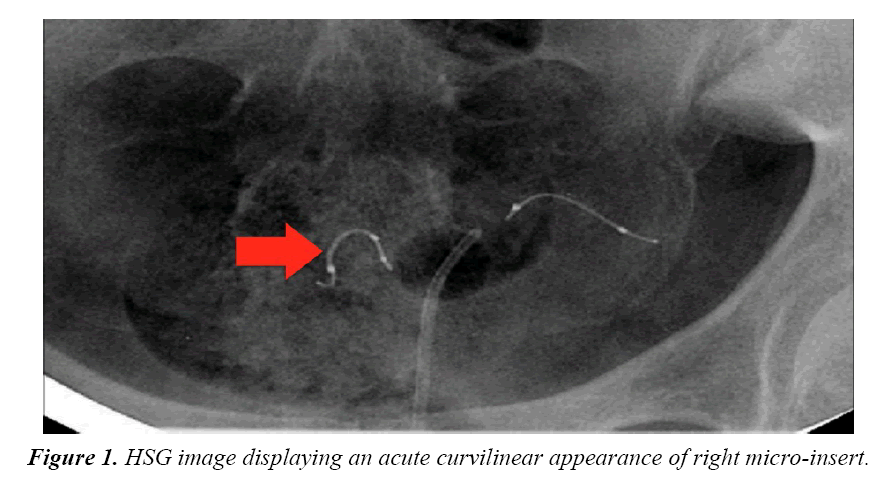 best of Post radical hysterectomy after essure