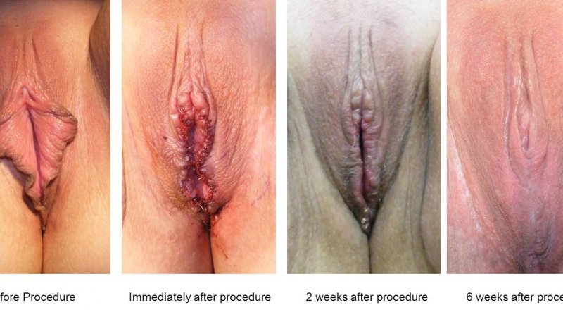 Vaginal borth after multiple